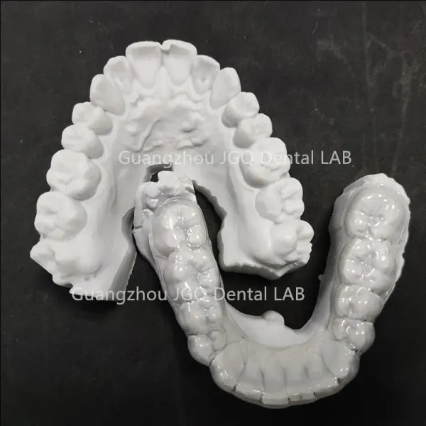 3D Printing Minimal Prep Orthodontic Arch Expander For Teenager