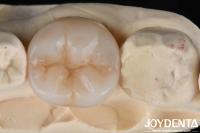 Multilayer Full Zirconia Ultimate Combination Of Strength And Aesthetics For Dental Restorations