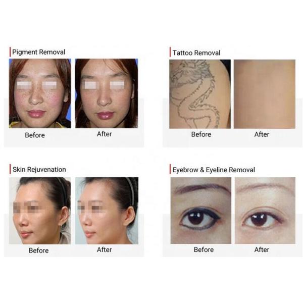 Portable Picosure Laser Machine , 755nm Picosecond Yag Tattoo Removal Machines