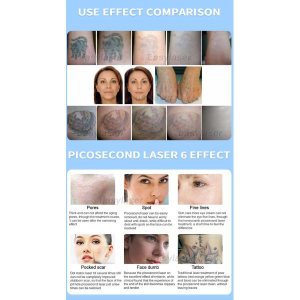 Vascular 980nm Laser Hair Tattoo Removal Machine Diode Pico Laser Machine