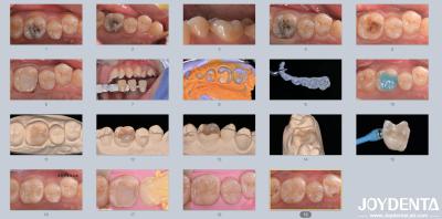 Adults Children Porcelain Ceramic Dental Inlay Restorative for Damaged Teeth