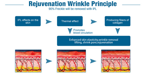 IMED profesional LaserTell de la máquina del retiro del pelo del OPT del rejuvenecimiento IPL SHR de la piel