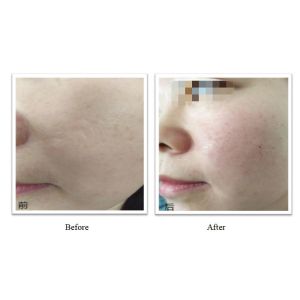 350 mg 150 mg PLLA Relleno dérmico OEM Personalización inyectable PLLA Para resultados duraderos