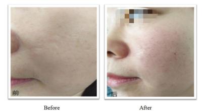 350mg 150mg PLLA Dermal Filler OEM Customization Injectable Plla For Long Lasting Results