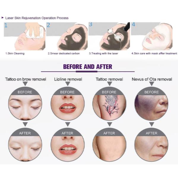 dispositif de laser de diode de chargement initial de 300W YAG pour l'épluchage de carbone de retrait de sourcil