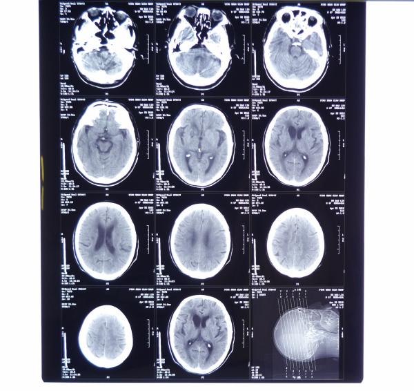 filmes secos da imagem latente médica do raio X de 10in * de 14in Digitas para as impressoras térmicas KND-F