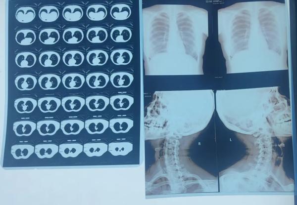 Medical Image System Laser X Ray Dry Film For DR CR MRI X - Ray Printer With CE ISO