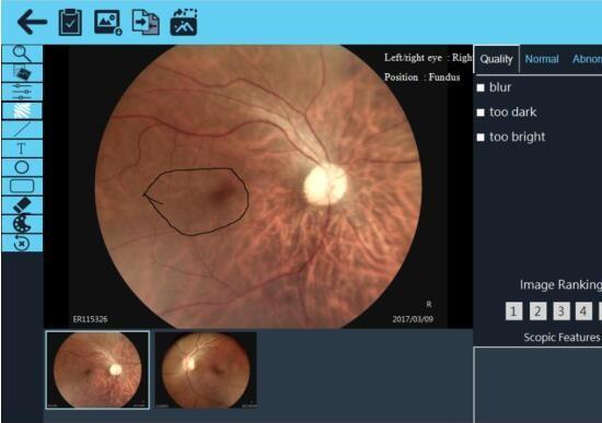 Ideal System For Telemedicine Application Portable Fundus Camera With 45° Auto Focus Non-mydriatic Technology