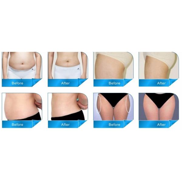 Body Shaper Fitness Hifu Beauty Machine Liposonix Fat Slimming Machine