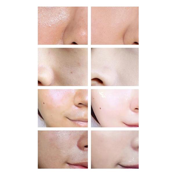 Acne Whitening Facial Skincare Set Cleanser Toner And Moisturizer With Papaya Extract Whitening