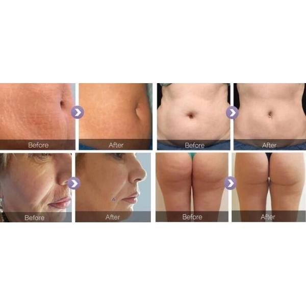 Тело ультразвука уменьшая потерю веса воздушного давления ролика вакуума машины 40к