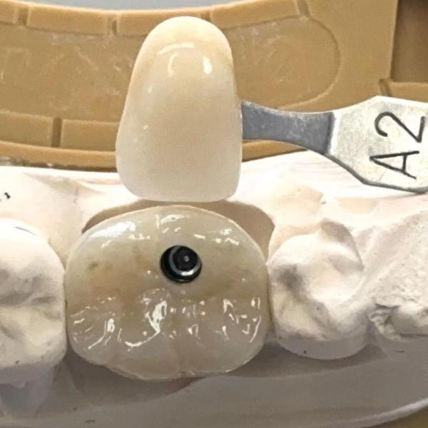 Porcelaine Zirconia Ciment Implanté à vis retenue Forme de tête hexagonale pour une esthétique personnalisée