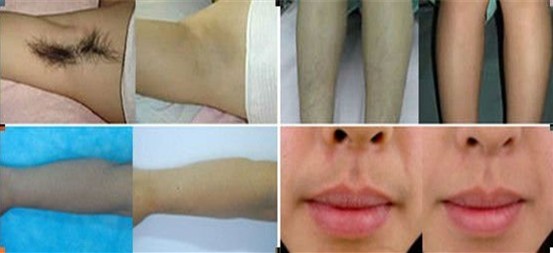 high performance 808 diode laser hair removal machine for total painless hair removal
