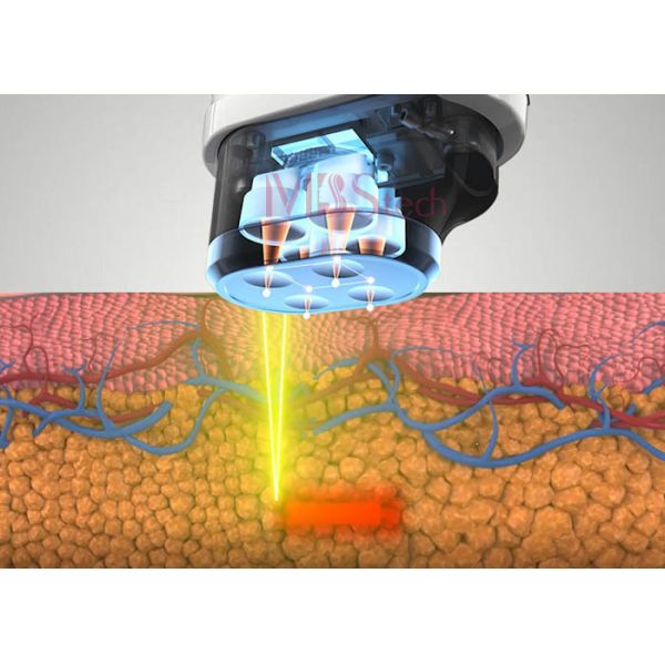 Подниматься стороны 5D холодной кожи 5 охлаждая патронов безболезненный HIFU