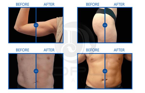 RF EMS Sculpting Machine EMS Muscle Stimulator Pro Max With 4 Handles