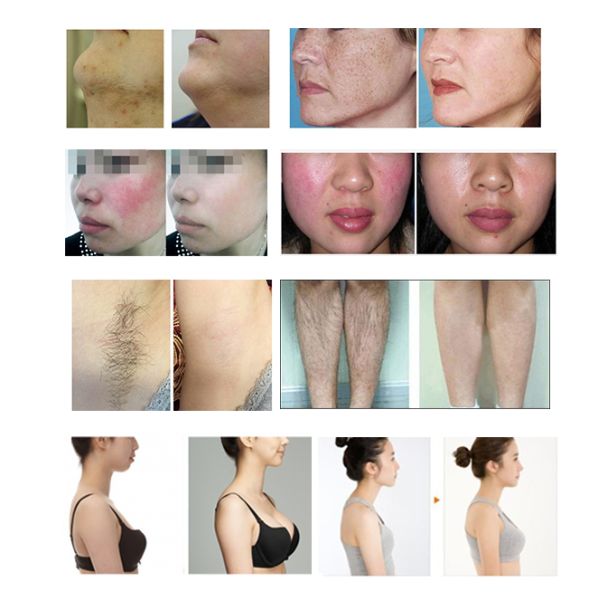 Máquina libre del retiro del pelo de la luz de Shr IPL E del dolor