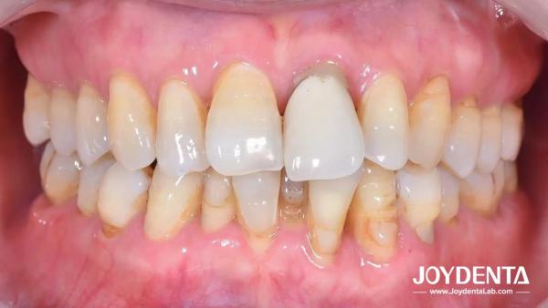 Zirconia dentures that imitate natural teeth