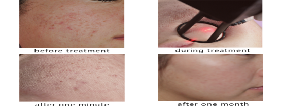 Машина лазера вертикального СО2 Рф дизайна частичная с влагалищной затягивая функцией