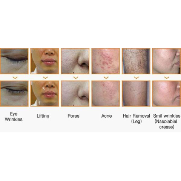 Мини ИПЛ эпилятор для домашнего использования лазерный эпилятор