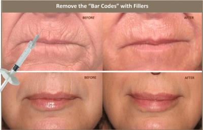 enchimento 10ml cutâneo ácido hialurónico injetável para corrigir a assimetria facial