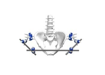 Orthopedic Brace External Fixation System Dissection IV Φ8-Pelvic Fixation