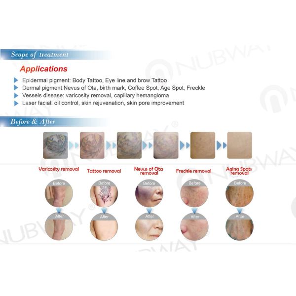 Professional 1064nm 532nm q switched nd yag laser/Laser tattoo removal machine