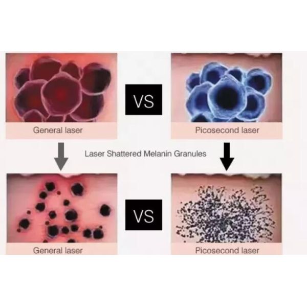 Multifunctional Salon ND Yag laser surgery tattoo removal Machine 1 - 6Hz Pulse Repetition Rate