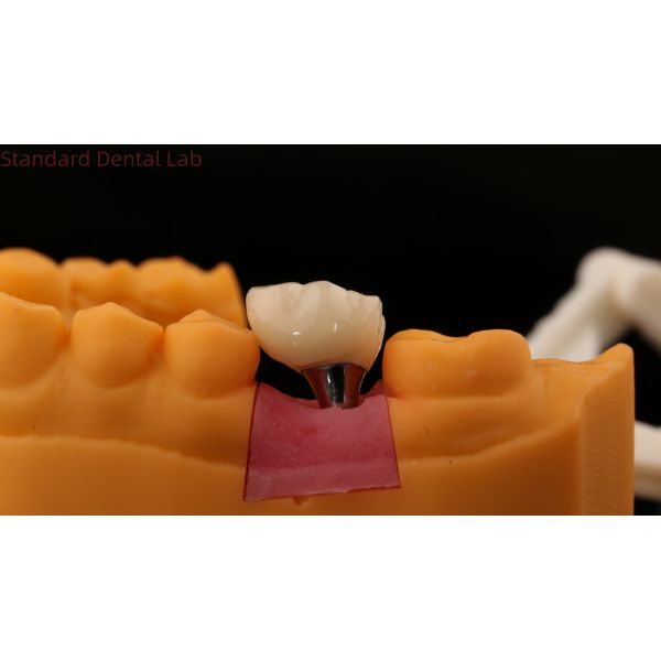 Screw Retained Dental Implant Crown Dental PFM Crown With 3D Print Model