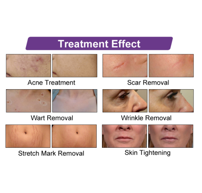 RF Metal Co2 Fractional Laser Equipment Scar Removal Vaginal Tightening