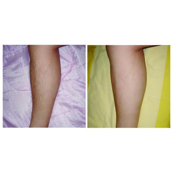 Medical Ipl Shr Hair Removal Machine , Vertical Type Ipl Hair Reduction Machine