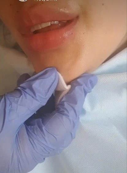 Gel médico 2ml, llenador cutáneo de Hyaluronate del sodio de la seguridad de la ha de la inyección de la cara