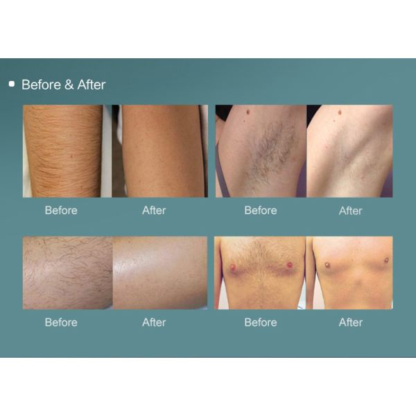 120 J/CM 600w Diode Laser Hair Removal Ladies Salon Ipl Machine