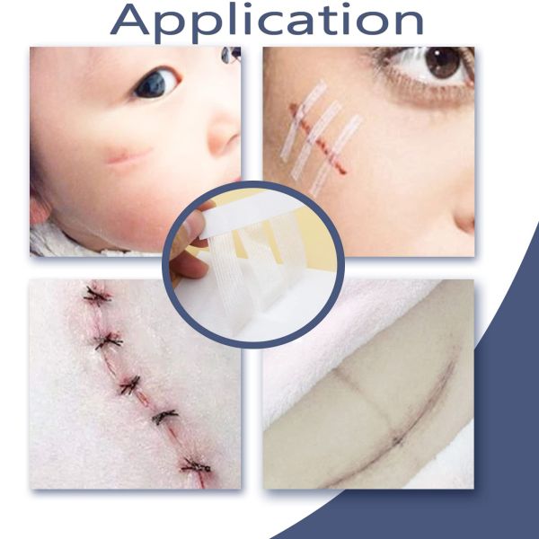 Hospital Surgical Sterile Wound Closure Strips Athletic Adhesive Skin Closure Strip