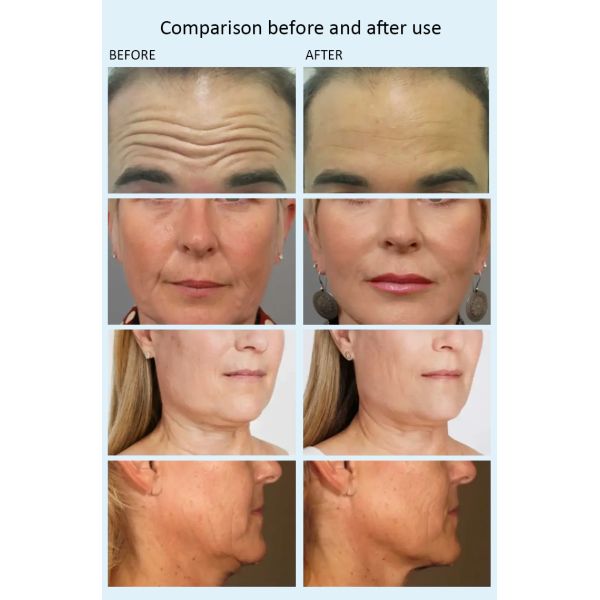 Astiland Needle Free Anti Aging EMS Muscle Stimulator Электрическая магнитная скульптурная машина для косметического спа для лица