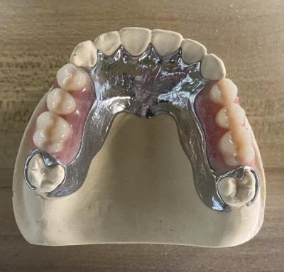 High Strength Casting Metal Partial Denture Cocr Aolly With 3D Printing