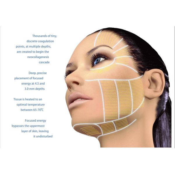 Best Facial Skin Lifting Wrinkel Remover Ultrasound HIFU/ Portable HIFU Slimming Machine