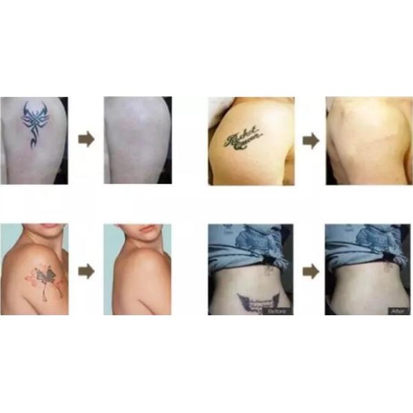 переключенная к машина лазера яг нд