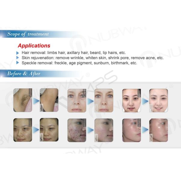 soprano diode laser skin hair removal ipl machine intense pulsed light machine