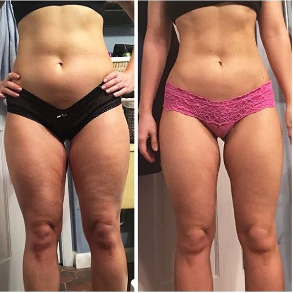 Masque à rouleaux 5d pour éliminer la cellulite