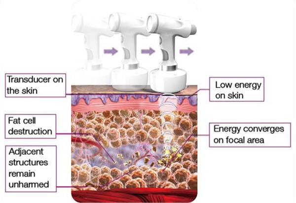 10Mhz liposonix hifu for fat reduction high intensity focused ultrasound 300W hifu for body slimming HIFUmachine