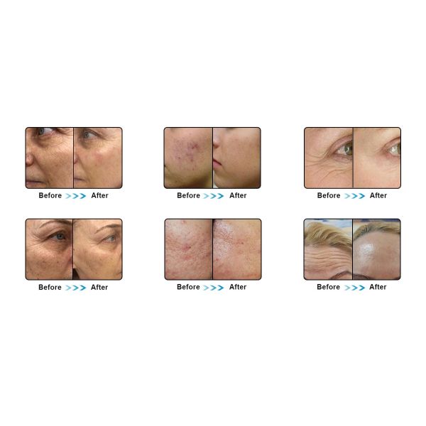 кожа подтяжки лица затянуть машину кожа RF protable иглы Mrico радиочастоты частичная затягивая машину Microneedle частичную Rf