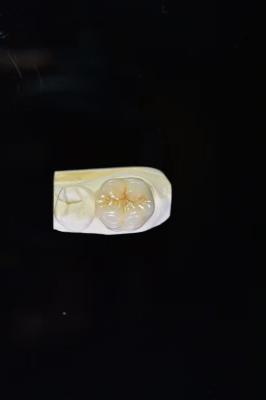 Longevity And Durability A Lifetime Investment With Our Ceramic Dental Crowns
