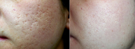 Инновационная технология восстановления кожи для всех типов кожи