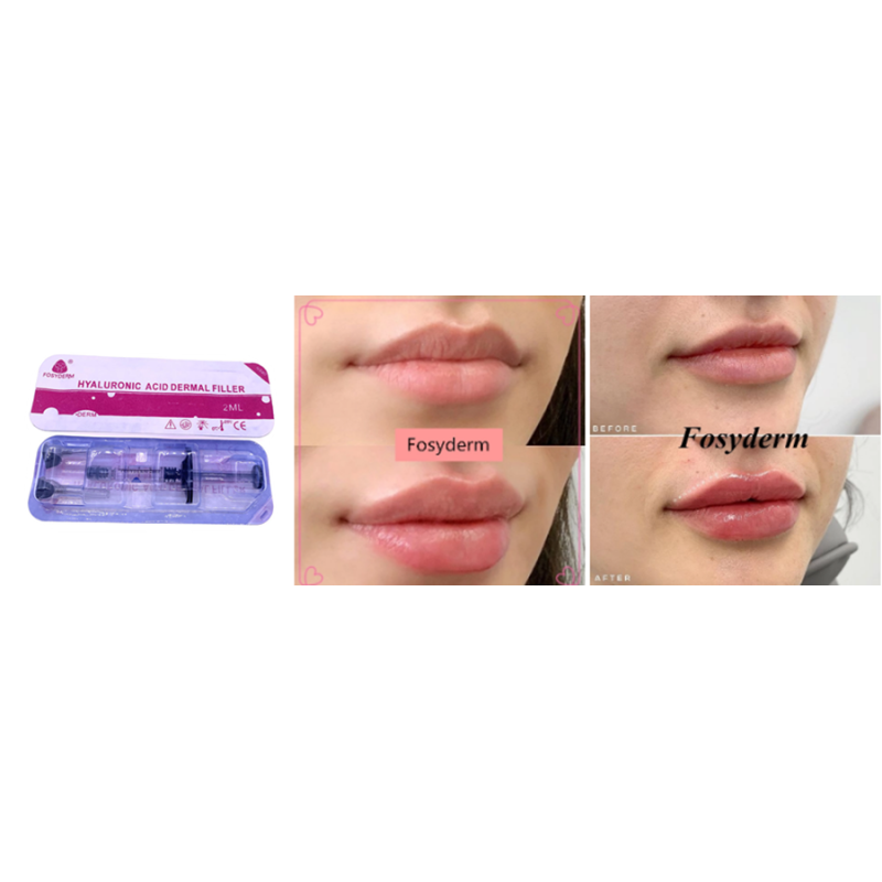 Fosyderm Hyaluronic Acid Facial Filler Dermal filler injection