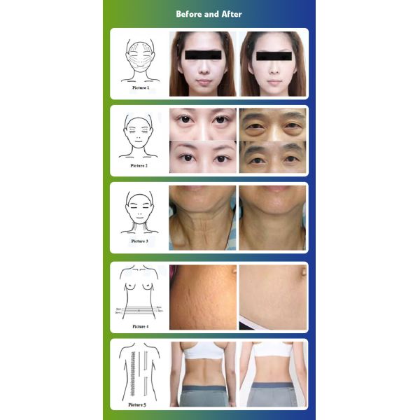 Vacuum Roller Body Shaping Lymphatic Drainage Slimming Body Contouring Machine