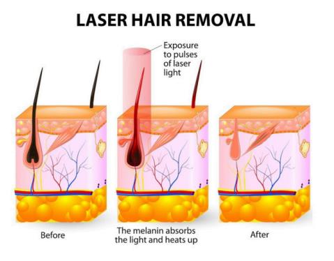 LCD Touch 810nm Diode Laser Depilation Equipment For Commercial