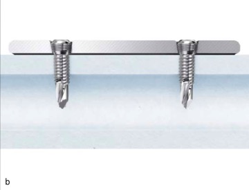 Запирающая пластинка 3,5 Humerus Lcp дистальная для Intraarticular трещиноватостей