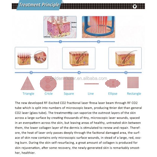 Алюминиевая коробка, фракционная лазерная машина с способностью восстанавливать