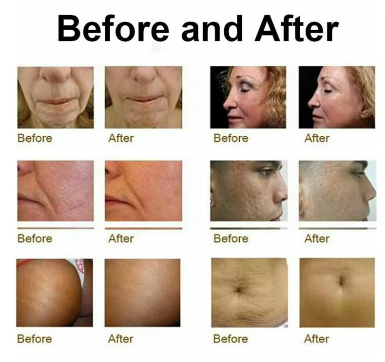 Skin Tightening Skin Rejuvenation 2 In1 Microneedling Fractional RF Machine