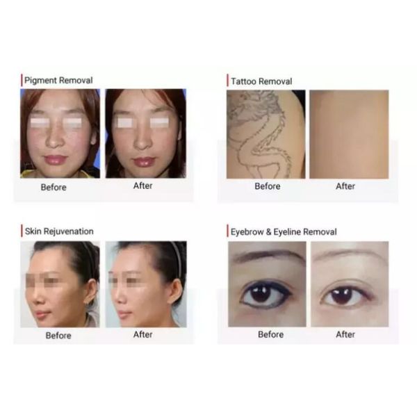 Portable Q Switched Nd Yag Laser Machine For Tattoo / Pigmentation Removal